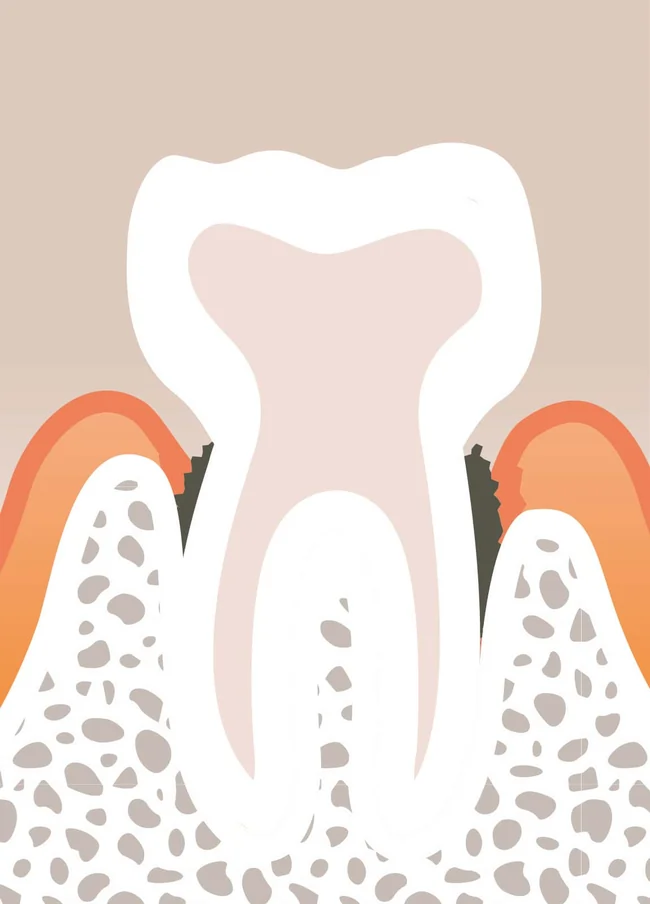 Parodontitis, Zeichnung einer Zahnfleischentzündung